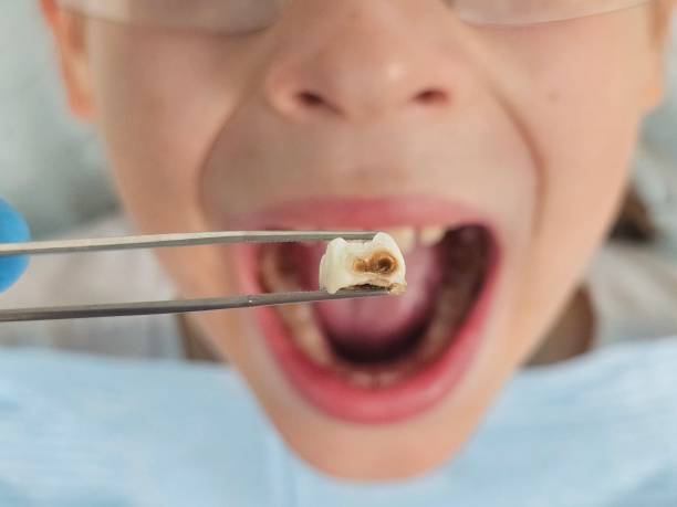 Best Urgent Care for Lost Fillings or Crowns in Hanford, CA